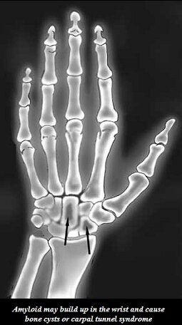 Amyloid may build up in the wrist and cause bone cysts or carpal tunnel syndrome.
